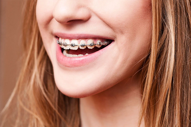 Orthodontics in San Jose